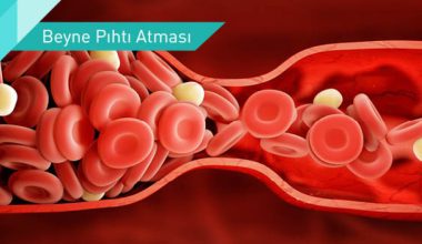 PIHTI ATMASI NEDİR ?