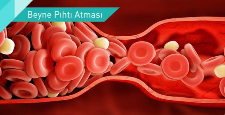PIHTI ATMASI NEDİR ?
